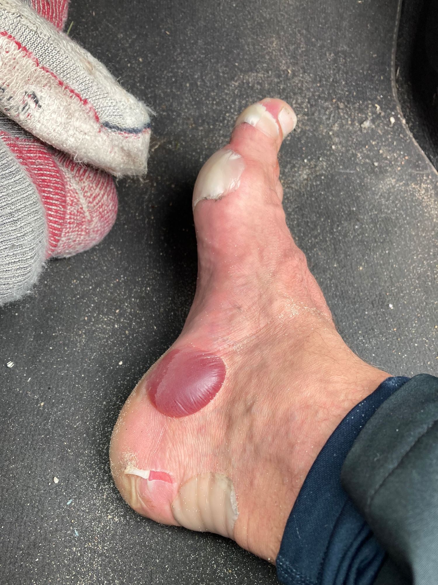 A bare foot with a large blood blister on the heel and blisters on the toes after the walk
