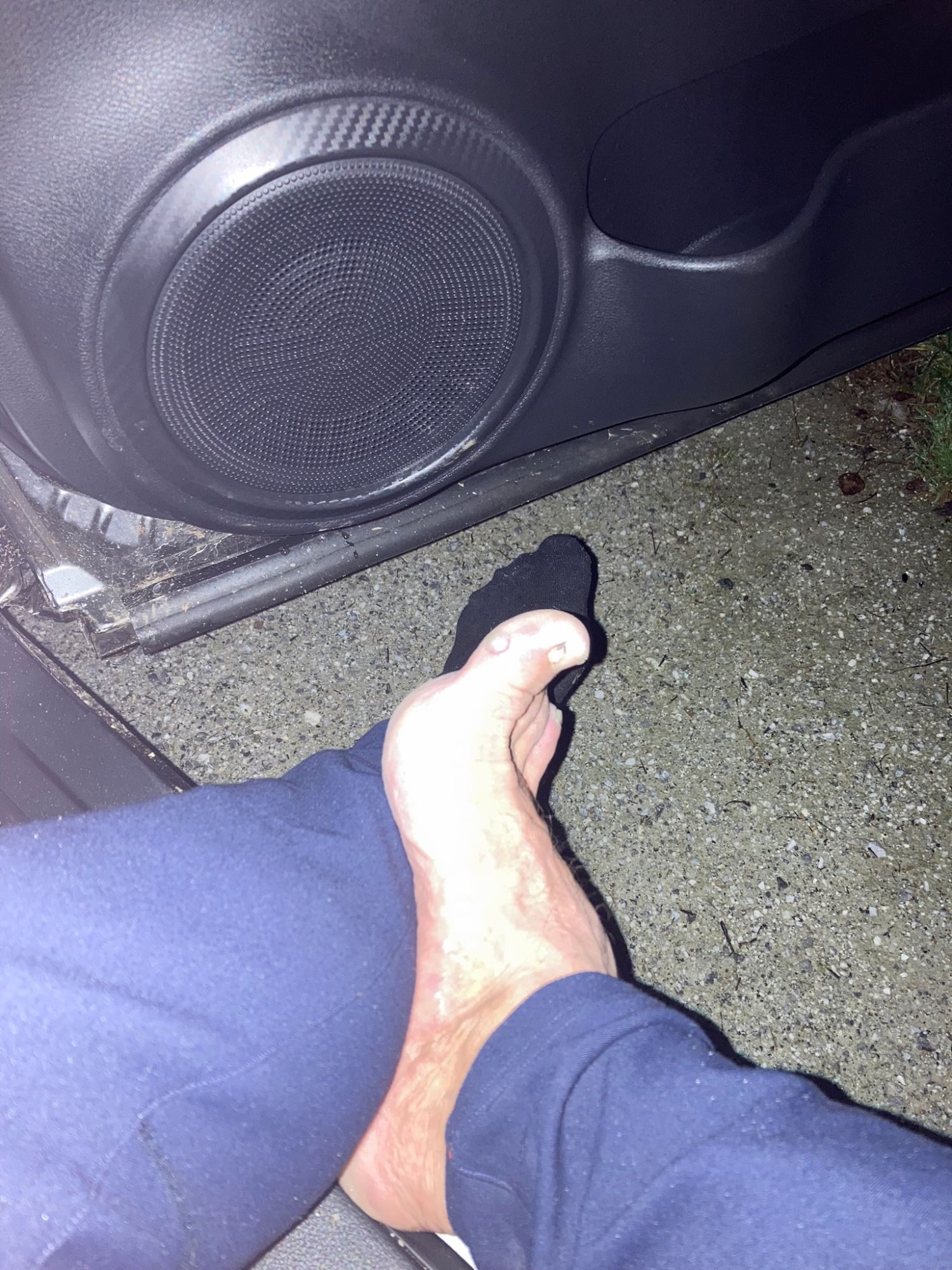 A bare foot with blisters on the toes, half out of a sock, in the open car door at night